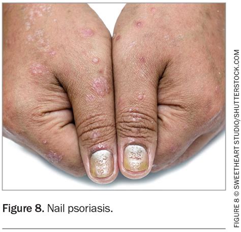 Psoriasis – presentation, types and management | Medicine Today