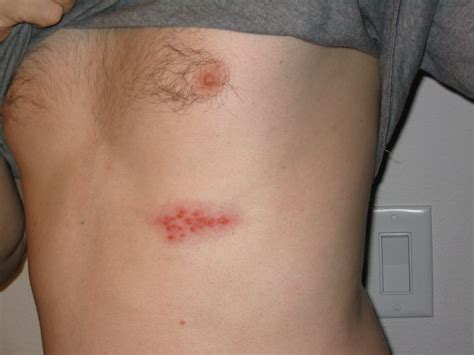 Herpes Zoster (Shingles) | Concise Medical Knowledge