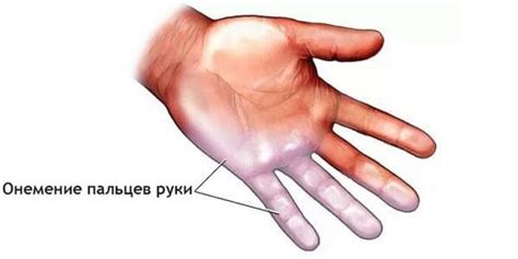 Немеют пальцы на руке и ногах: причины и профилактика