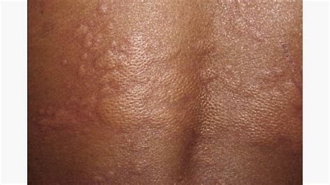 Breaking Out in Hives for No Apparent Reason