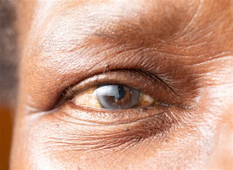 What Is Floppy Iris Syndrome?