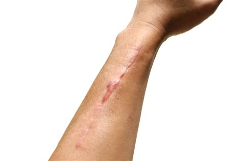 scars  surgical scars indulgence