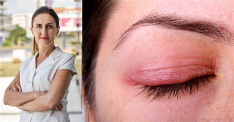 Alergijski konjuktivitis - PORTAL ZA ZDRAV POGLED