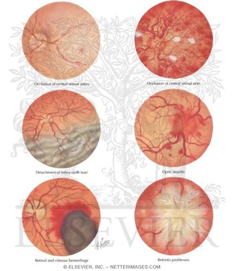 Optic Nerve Lesions