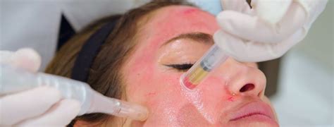 PRP Skin Treatment with Microneedling - Dr. Niketa Sonavane
