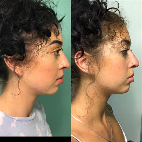 My two month progress photo of intuitive mewing. Wasn’t sure if it was ...