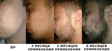 Алерана — средство для бороды — BorodaDeda.ru