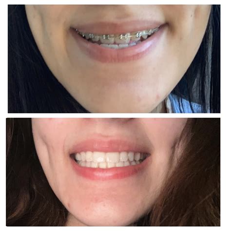 Class Ill Underbite Fixed with braces (NO jaw surgery)- UPDATE : r/braces