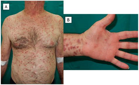 Primary Syphilis Rash