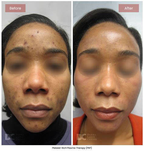 Platelet-Rich Plasma Therapy New Jersey | PRP for Skin Rejuvenation