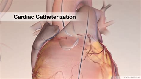 heart catheterization   lorraine bailey blog