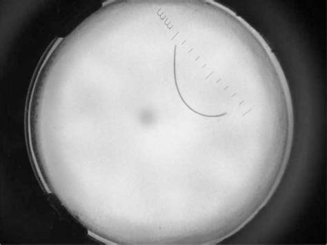 Man's Foot Pain Was Due to Rare 'Hair Splinter' | Live Science