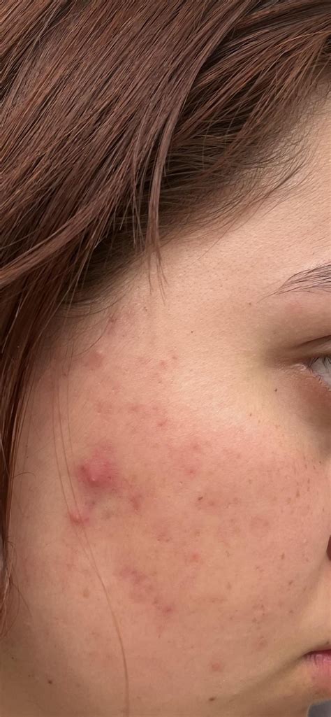 rid   redness left   acne racne