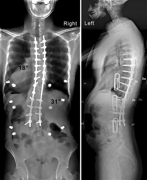 A novel duraplasty technique following fenestration of a massive lumbar ...