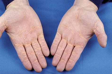 Xanthoma Striatum Palmare - MEDizzy