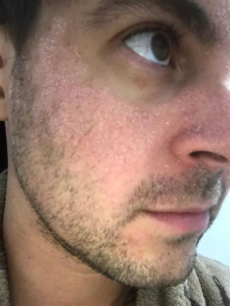 Man who suffered from 'red and blotchy skin for years' discovers why ...