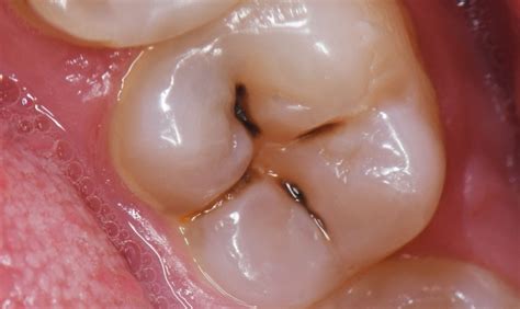 cavity  prevention tips