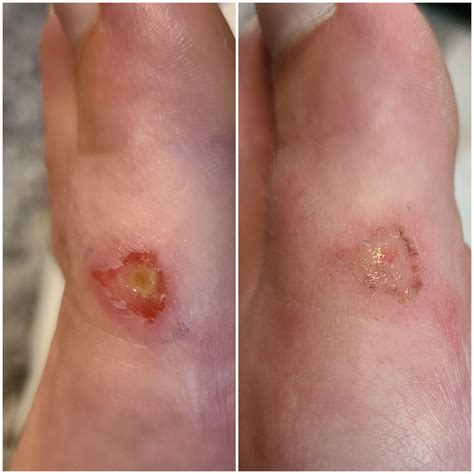 Is this mrsa or a brown recluse bite? I've found a few in my house