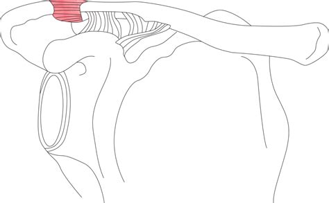 AC JOINT ARTHROSIS - Gloucestershire Shoulder Clinic