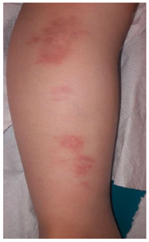 erythema migrans