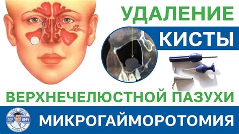 Удаление кисты верхнечелюстной пазухи (полная операция) - YouTube