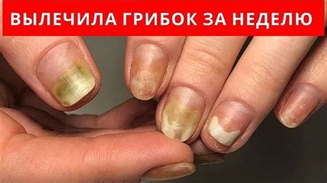 ВЫЛЕЧИЛА ГРИБОК ногтей за 1 НЕДЕЛЮ | Лечение ног, Лечение ногтей ...