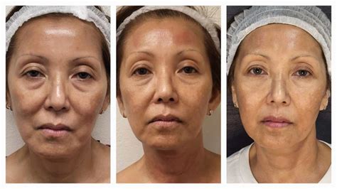 Fotona 4D Facelift - Granada Hills Med Spa