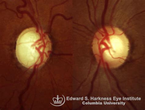 Glaucomatous Optic Nerve | Vagelos College of Physicians and Surgeons