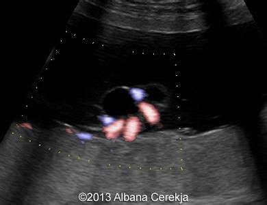 📃 Umbilical cord cysts, 2 cases