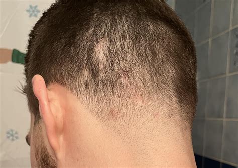 Possible ruptured Cyst : r/DermatologyQuestions