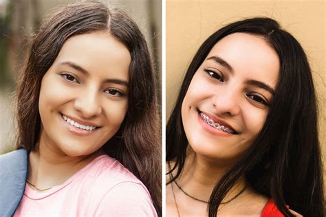 how to fix overbite naturally 3