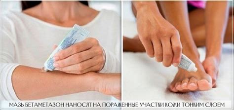Бетаметазон мазь (крем) – подробная инструкция по применению, состав ...