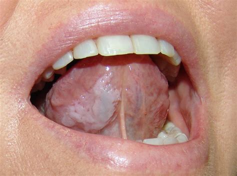 leukoplakia causessymptomstreatments oral cancer medegurumed  guru