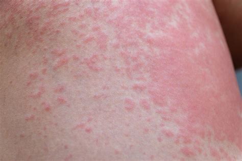 Rashes Beverly Hills | Treatment of Rashes Torrance | Encino, CA