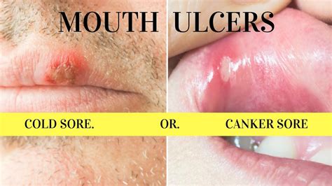 mouth sores  ulcers canker sore aphthous ulcer