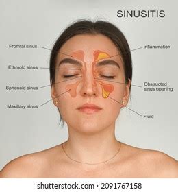 sinusitis healthy inflammation nasal sinus medical stock photo