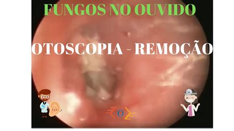 Fungo No Ouvido E Perigoso