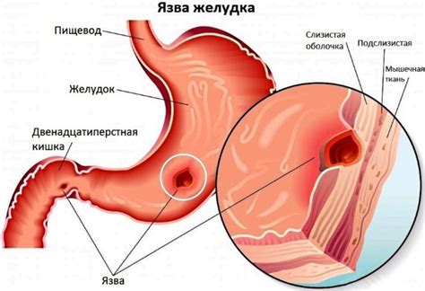 Язва желудка стол 1а - 86 фото