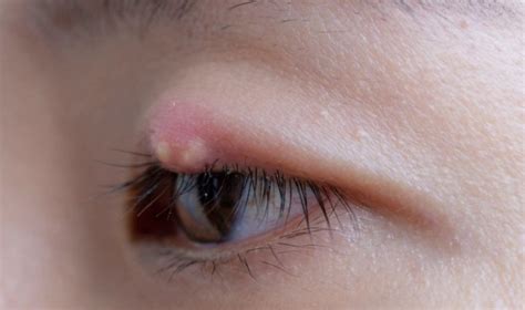 A fascinating eye cyst. : r/PoppingPimples