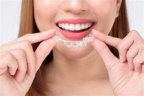 full invisalign process step  step aria dental