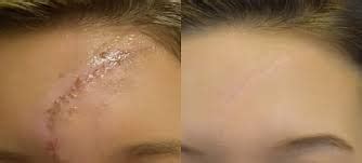 Red Light Therapy For Surgical Scars