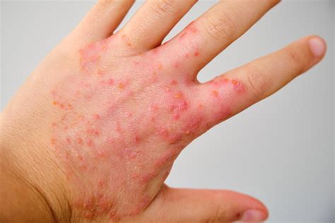 Delgocitinib Cream Update: Leo’s Topical Pan JAK Inhibitor Hits All ...