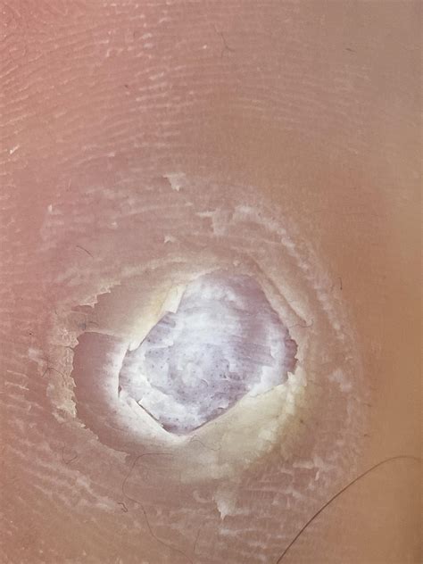 Extremely painful plantar warts caused by 15+ years treatment : r/Warts