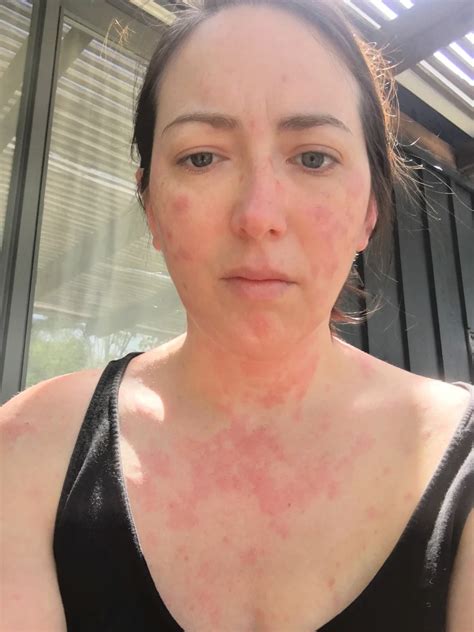 What Hives Feel Like, According to Real People - GoodRx