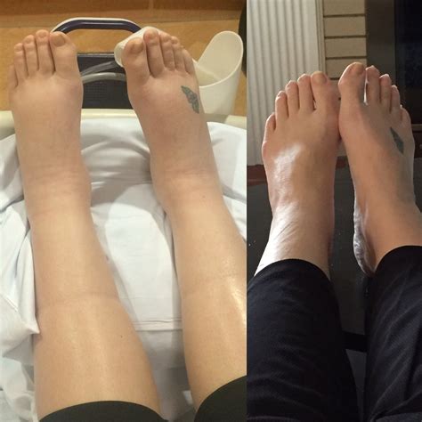 Postpartum swelling? — The Bump