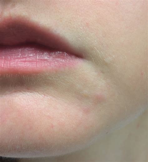 Perioral Dermatitis? Rosacea? Allergy? (Pic) – Rosacea & facial redness ...