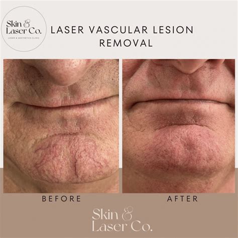 Facial Veins Treatment - Skin Laser Co
