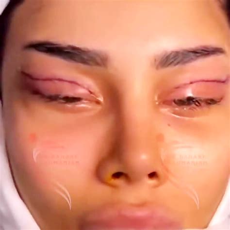 جراحی چشم گربه ای