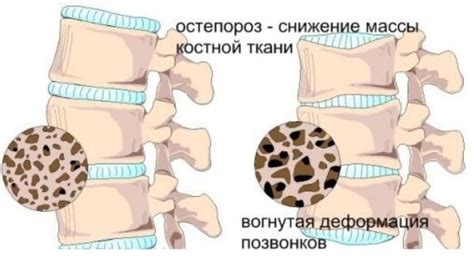 Можно ли делать массаж при остеопорозе