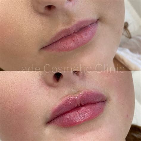 Lip Filler | Brisbane, Edge Hill & Trinity Beach